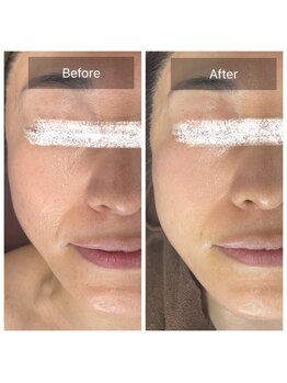 ラビ(RABBI)/40代女性小顔矯正