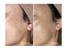 ベルティーク(BELTHEQUE)/ニキビケア