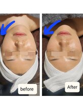 リラージェ 中目黒(Relaje)/※1回の施術効果before→After