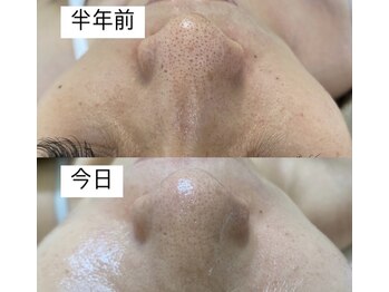 ミラージュ(Milarju)/毛穴洗浄/毛穴の黒ずみ/角質ケア