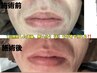 気になる箇所だけ脱毛したい方【Sパーツ脱毛¥2640】