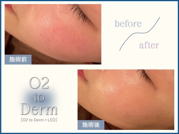 ヘティ バイ ソウル 中目黒(HETIY by Seoul)/O2 to Derm◇2回目