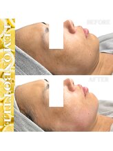 リアム(LiAm)/脂肪分解剤《レモンボトル》