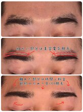 ベビースキン(baby skin)/美容電気脱毛とLED脱毛