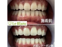 ルブラン 奈良店(Le Blanc)/マスク外す前にホワイトニング！