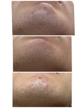 ルアナ(Luana)/メンズヒゲ脱毛★