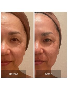 ルナスーリヤ 表参道店/ハーブピーリングbefore after