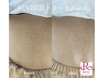 アノネ(Anone.)/美背中ハーブBefore After