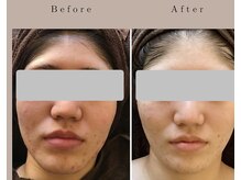 なごみ/肌質改善【ハーブピーリング】