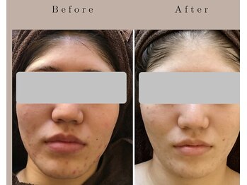 なごみ/肌質改善【ハーブピーリング】