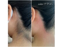 ソワン(soin)