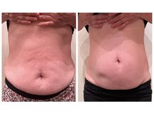 マンマ ジュンナ/サーマルボディ7回でこの結果！