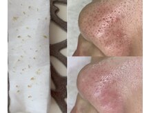 サロンド ケイティ(Salon de Katy)の雰囲気（取れた角栓が見れる！毛穴洗浄/毛穴/毛穴黒ずみ/毛穴ケア/毛穴）