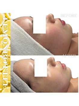 リアム(LiAm)/脂肪分解剤《レモンボトル》