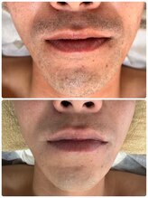 ティアレ 廿日市店(Tiare)/髭脱毛　ひげ　爆抜けモード