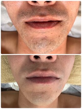 ティアレ 廿日市店(Tiare)/髭脱毛　ひげ　爆抜けモード