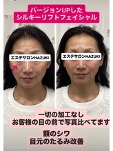 ハズキ(HAZUKI)/たるみ改善