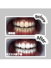 ザ ホワイト(THE WHITE)/ビフォーアフター初回