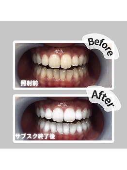 ザ ホワイト(THE WHITE)/ビフォーアフター初回