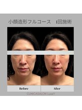 リュクシー(LuxeY)/輪郭形成小顔たるみケア