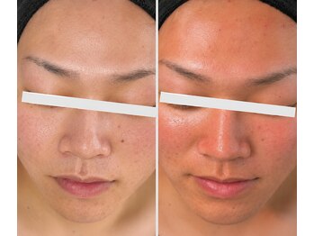 ビジュー(Bijou)の写真/【大人ニキビケア】赤み・肌荒れ改善
プラズマ肌質改善　　22000→7900