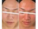 ビジュー(Bijou)の写真/【大人ニキビケア】赤み・肌荒れ改善
プラズマ肌質改善　　22000→7900