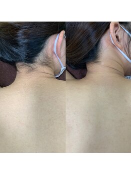 ミンエピ(MinEpi)/うなじのビフォーアフター