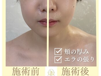 リコ(Rico)/即効性のある造顔マッサージ