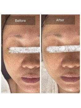 ラビ(RABBI)/50代女性小顔矯正EMS