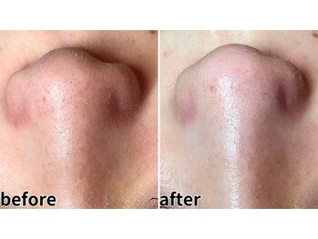 エヌエクラ(N.eclat.)/毛穴【1回目】