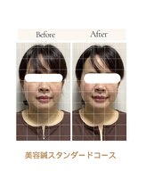 サロン ド ハリッシュ(Salon de HARISH)/リフトアップに◯