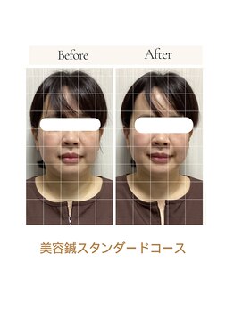 サロン ド ハリッシュ(Salon de HARISH)/リフトアップに◯