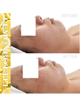 リアム(LiAm)/脂肪分解剤《レモンボトル》