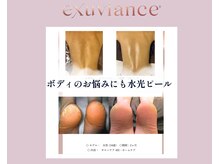 エテル(eter)の雰囲気(水光ピールは背中、デコルテのニキビ、ざらつき◎踵のひび割れも)