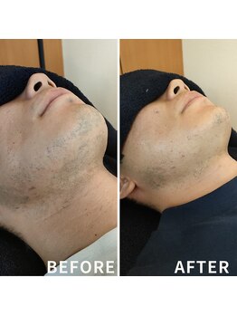 リズム(LISM)/ひげ2回照射後