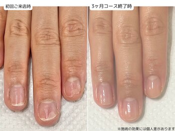 カピリナ(Ka Pilina)/自爪育成・川崎・深爪