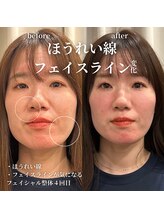 フェアリーフェイス 南森町店(Fairy Face)/南森町/小顔矯正4回目