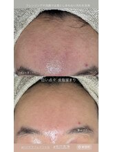 美顔秘密基地 新宮/お顔のざらつき毛穴洗浄で解決！