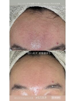 美顔秘密基地 新宮/お顔のざらつき毛穴洗浄で解決！