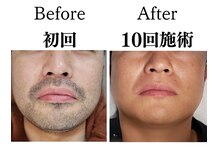 アールビューティ(R beauty)の雰囲気（気になる青ヒゲもここまで綺麗になる！ヒゲ脱毛で清潔感ＵＰ♪）