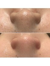 ノーブル 上土店(Noble)/毛穴洗浄BeforeAfter