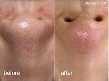 サロン ド ブラン アオヤマ(Salon de BLANC AOYAMA)/ハーブピーリング&ソノケア