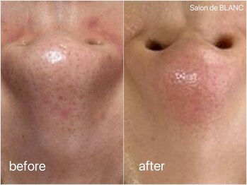 サロン ド ブラン アオヤマ(Salon de BLANC AOYAMA)/ハーブピーリング&ソノケア