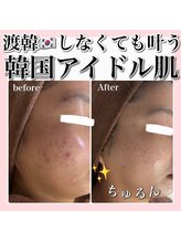 アルムダアクア 天王寺店(Aleumda AQUA)/ハーブピーリング/大阪/天王寺