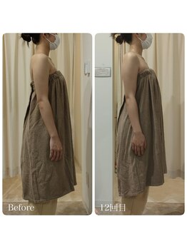 ルノン(Lunon)/《ブライダル》巻き肩・猫背調整