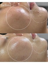 サロンナナジュウニ(Salon72)/ニキビ/肌荒れ