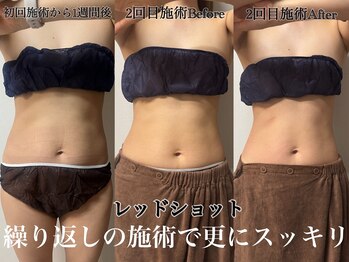 アンドエス 六本木(and S.)/お腹の脂肪分解レッドショット♪