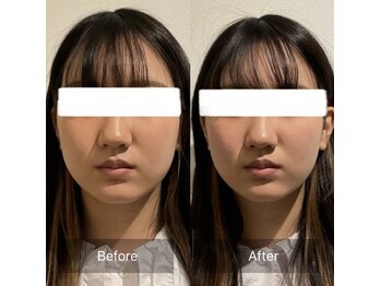 ハリナチュレ 神戸元町店/小顔美容鍼初回体験 BeforeAfter