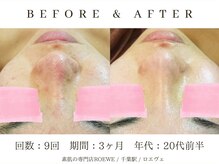 ロエヴェ(ROEWE)/ニキビ改善・毛穴ケア・肌質改善