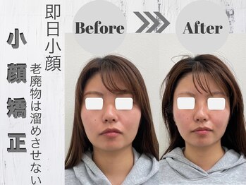 ルーナ(LUNA)/骨格からリフトアップ